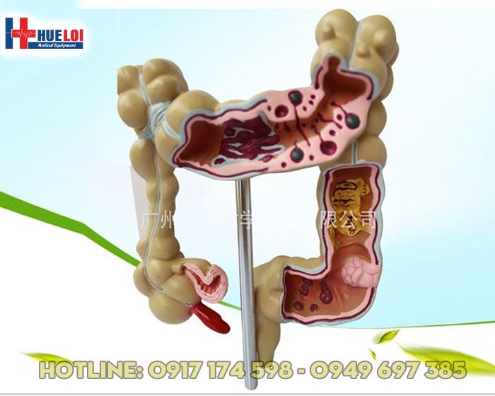 Mô hình khung đại tràng và các bệnh lý hay gặp