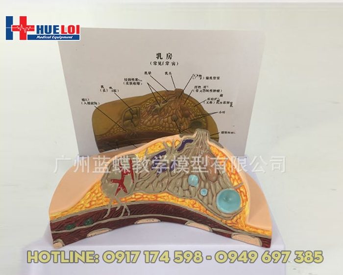 Mô hình tuyến vú và các bệnh lý hay gặp