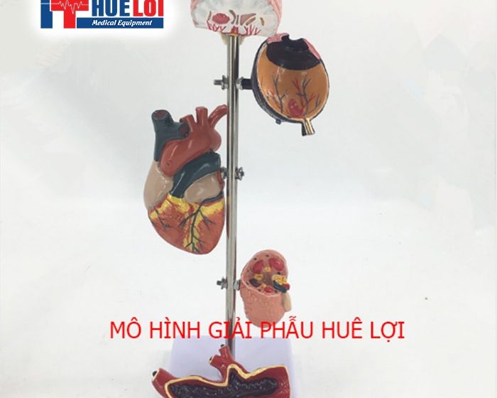 MÔ HÌNH BIẾN CHỨNG CỦA TĂNG HUYẾT ÁP