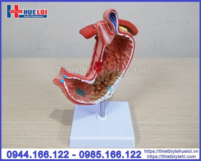 Mô hình bệnh lý dạ dày