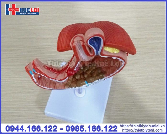 Mô hình bệnh lý dạ dày